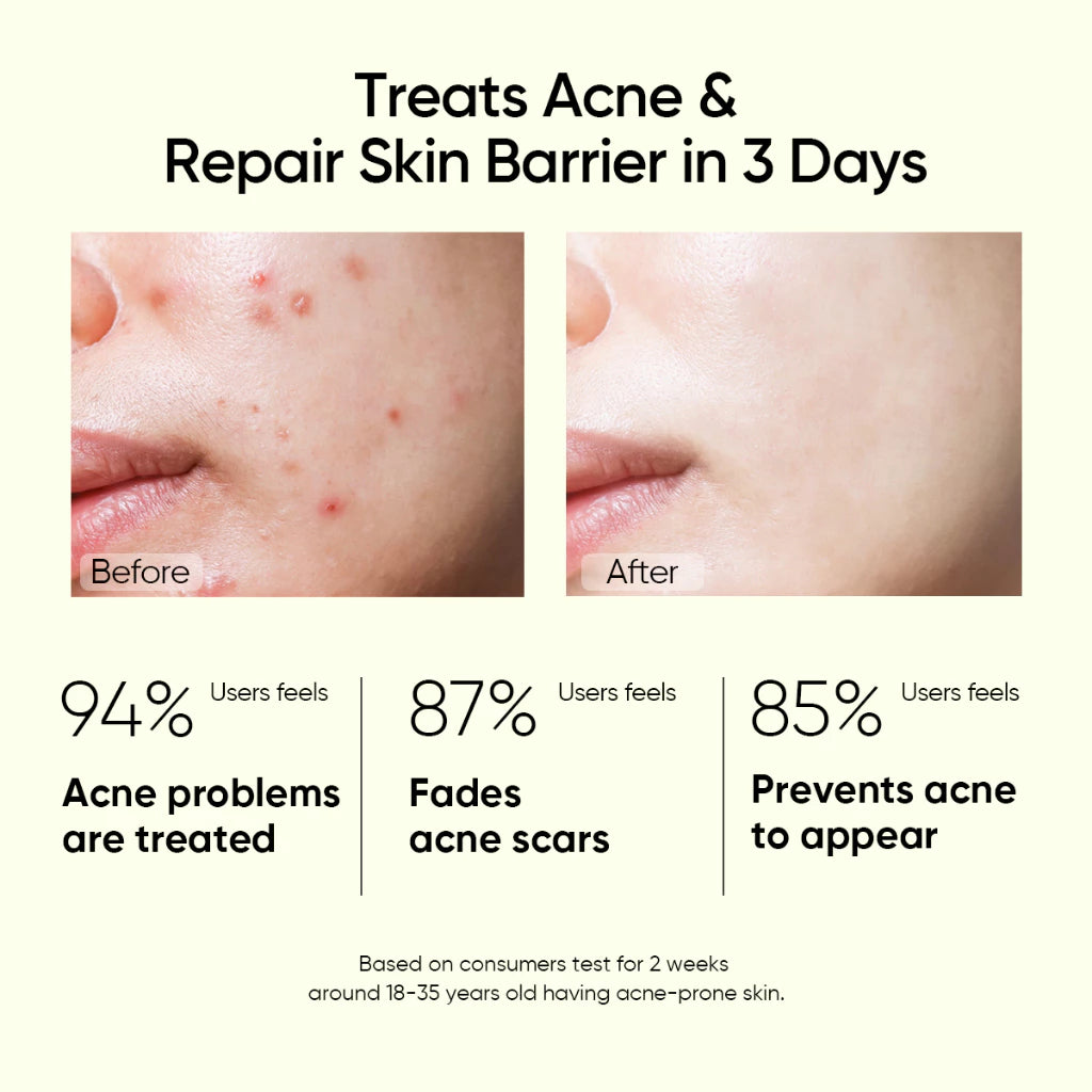 2% Salicylic Acid Anti Acne Serum